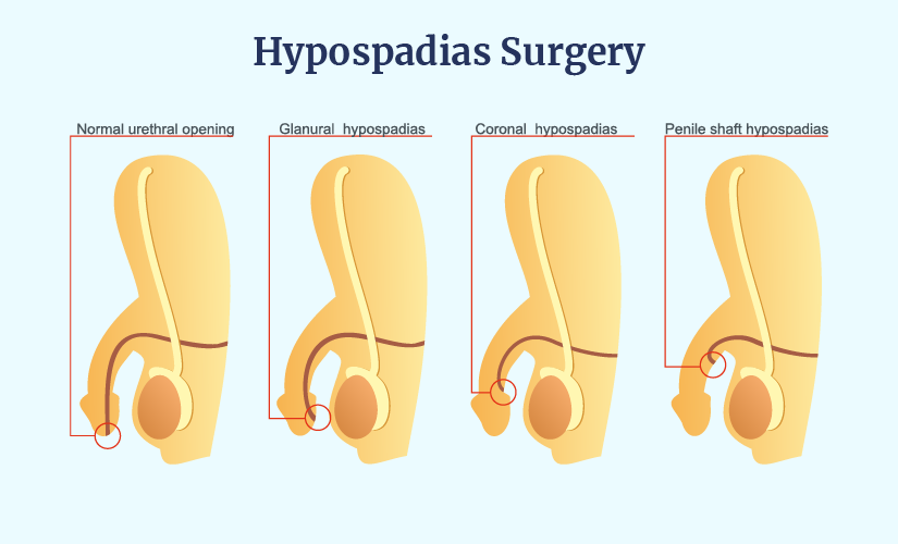 Hipospadias Nedir?