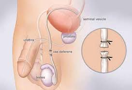Vazektomi Nedir?