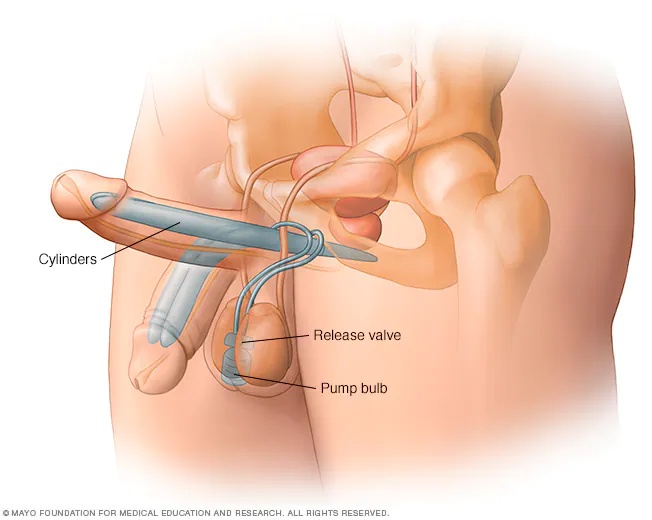 Penuma Implant Turkey