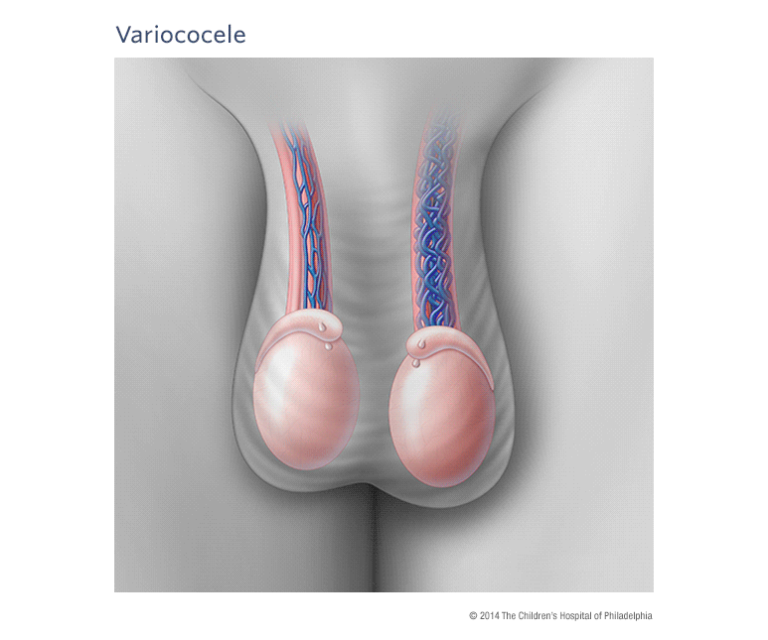 Varicocele